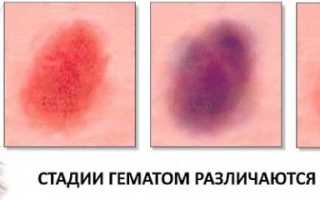 Что делать при сильном ушибе пальца на руке молотком
