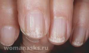 Ломкость ногтей: как вернуть былую красоту и твёрдость