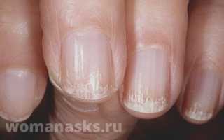 Ломкость ногтей: как вернуть былую красоту и твёрдость
