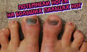 На ногте большого пальца ноги образовалось темное пятно?